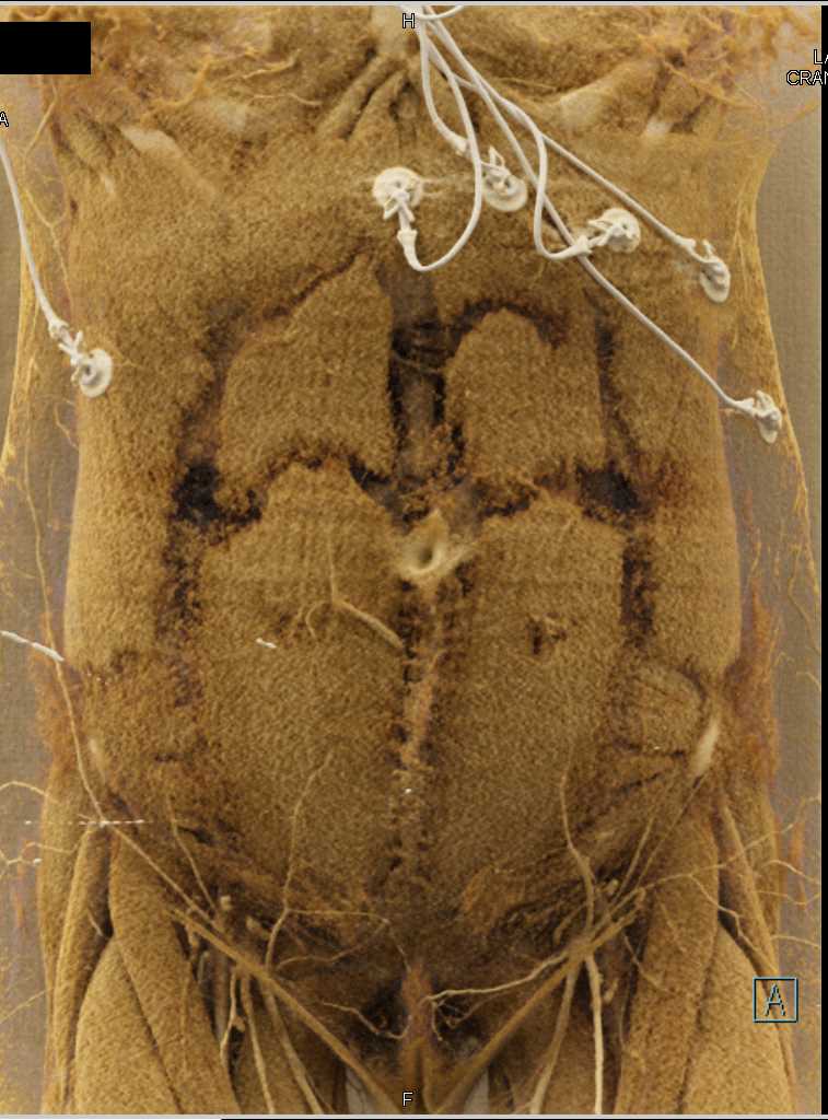 Cinematic Rendering of the Bladder - CTisus CT Scan