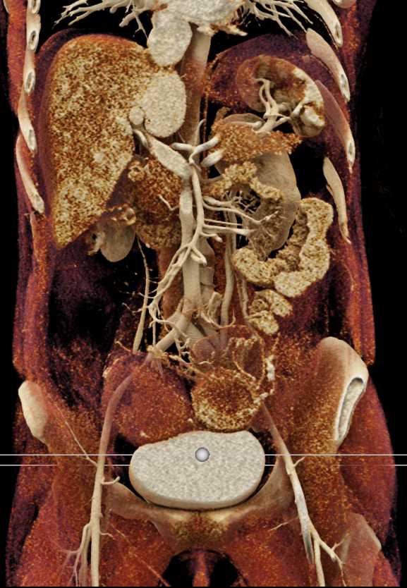 Cinematic Rendering of the Bladder and Ovarian Metastases - CTisus CT Scan