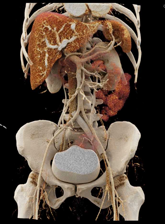 Cinematic Rendering of the Bladder and Ovarian Metastases - CTisus CT Scan
