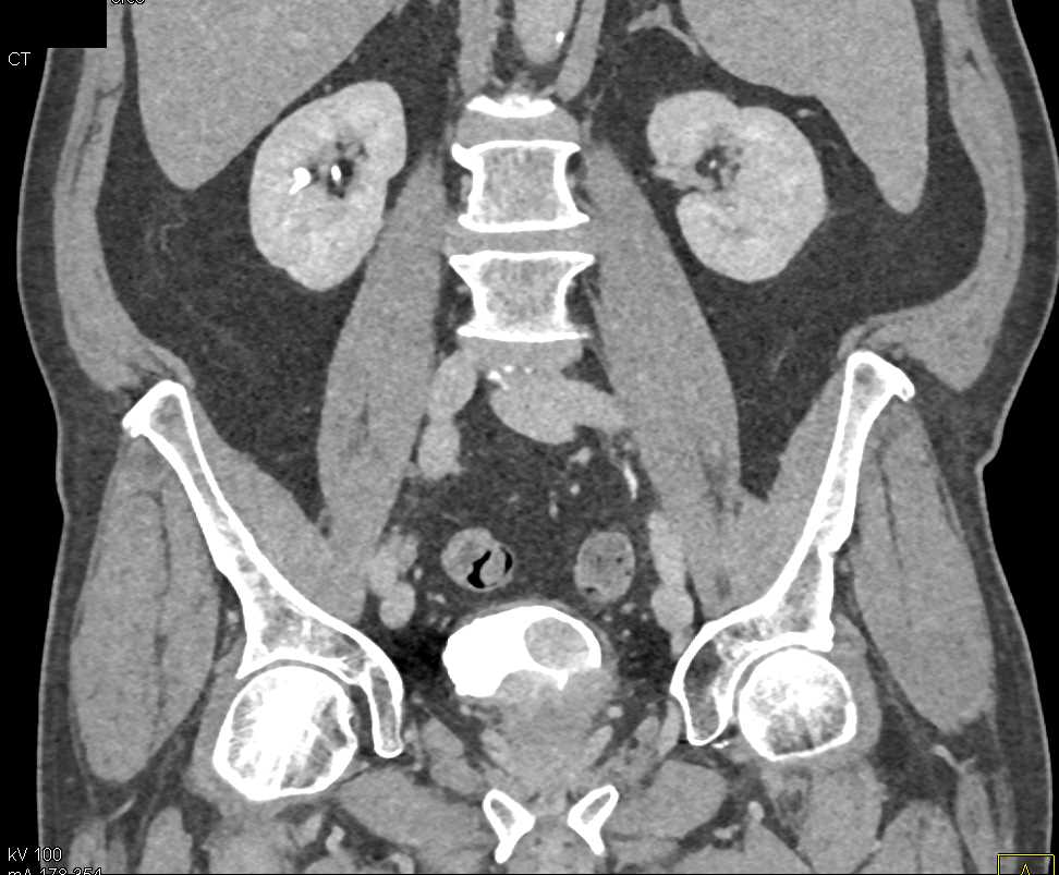 Prostate Cancer Involves the Bladder - CTisus CT Scan