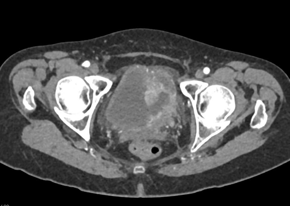Extensive Bladder Cancer - CTisus CT Scan