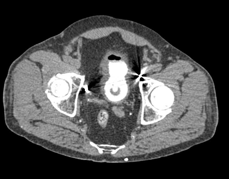 Dilated Renal Pelvises and Ureters with Thickened Wall Bladder - CTisus CT Scan