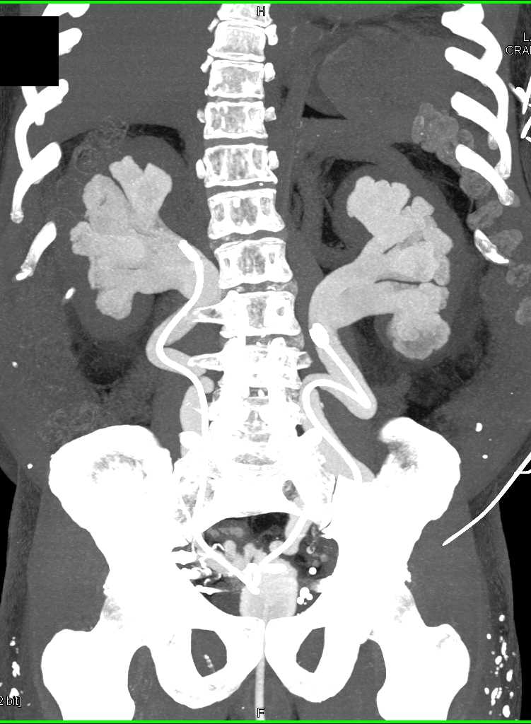 Dilated Renal Pelvises and Ureters with Thickened Wall Bladder - CTisus CT Scan