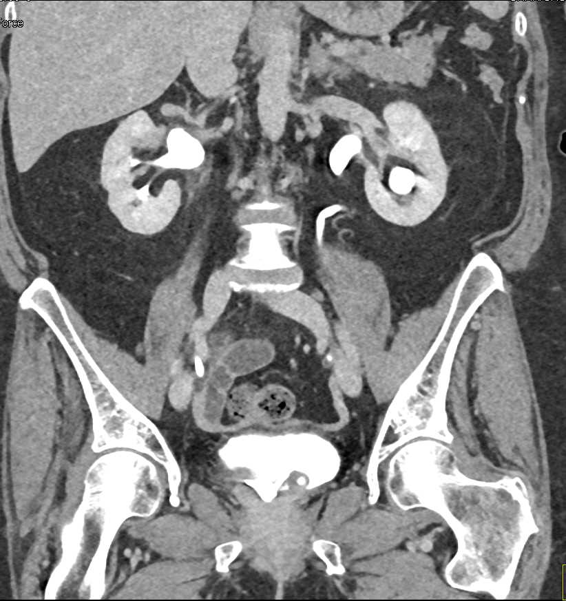 Inflammation Right Ureter - CTisus CT Scan