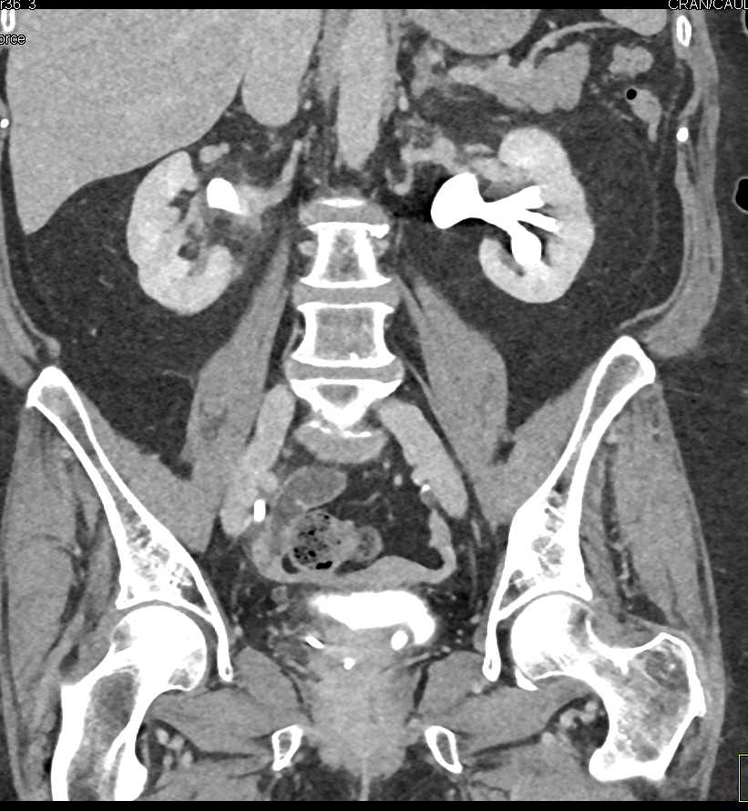 Inflammation Right Ureter - CTisus CT Scan
