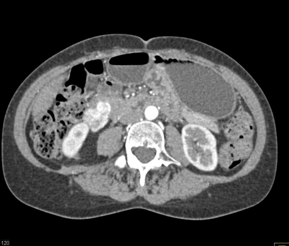 Paraganglioma - CTisus CT Scan