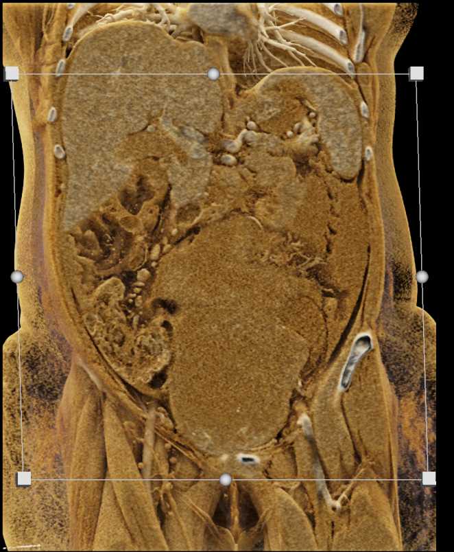 Complex Cystic Pelvic Mass due to Ovarian Carcinoma with Cinematic Rendering - CTisus CT Scan