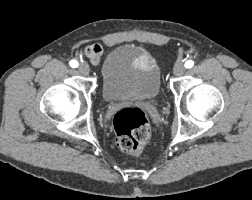 Enhancing Bladder Cancer is a Polypoid Mass - CTisus CT Scan