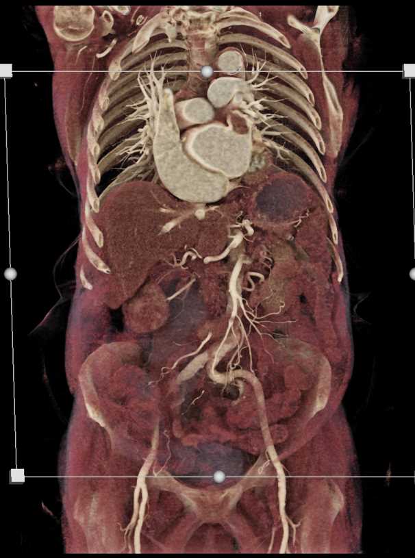 PE and Left Atrial Thrombus in Patient with Bladder Cancer - CTisus CT Scan