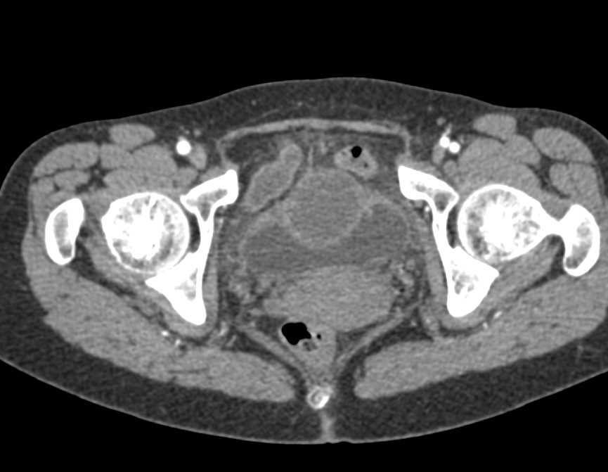 Urachal Carcinoma of the Bladder - CTisus CT Scan