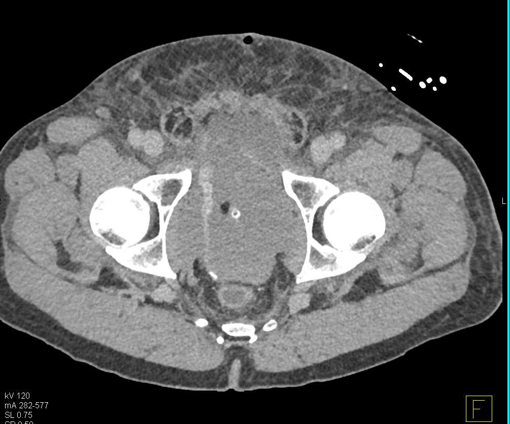 Bladder Injury with Bleed - CTisus CT Scan