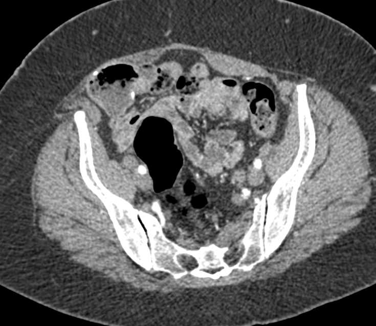 Obstruction Left Ureter due to Metastases - CTisus CT Scan