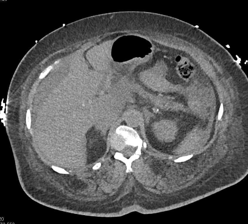 CT Cystogram with Leak - CTisus CT Scan