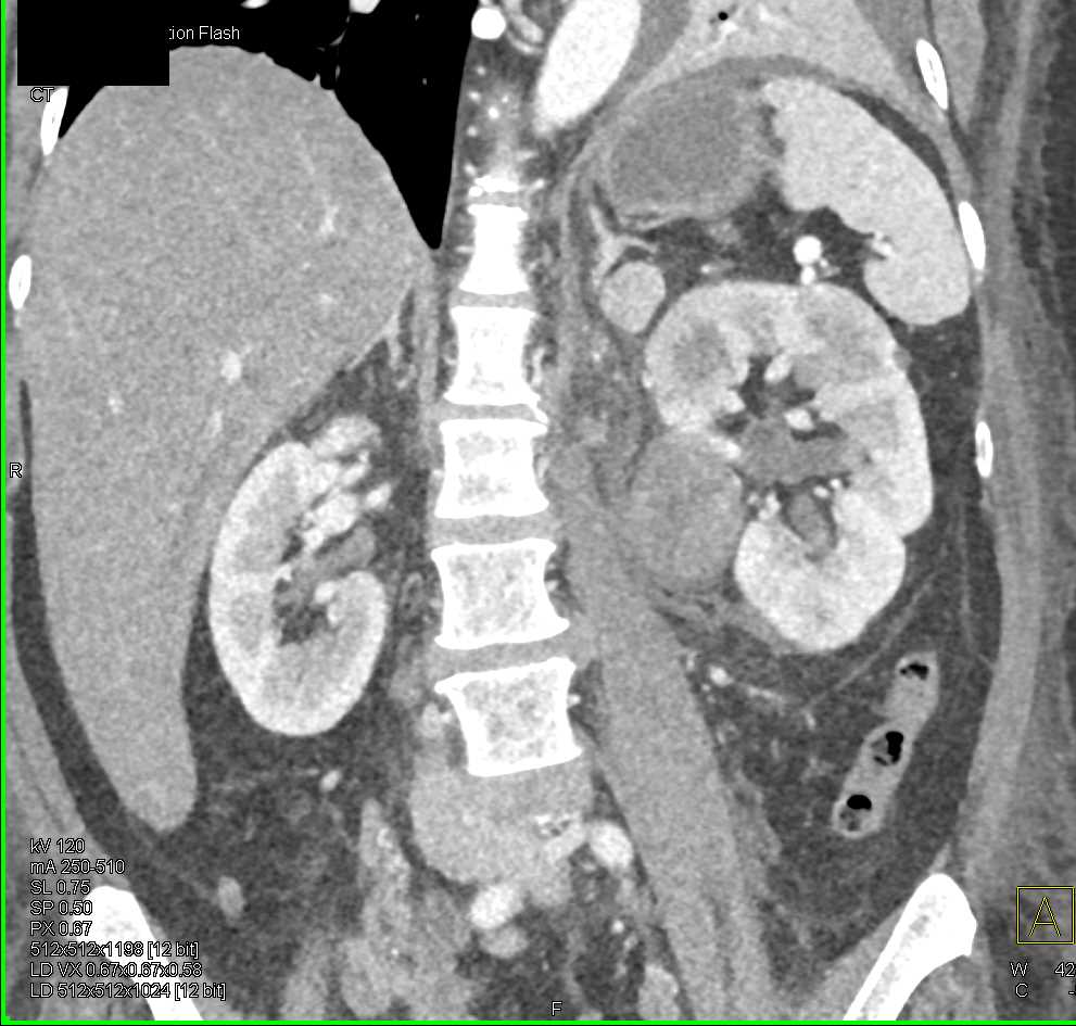 Lymphoma Involves the Left Kidney - CTisus CT Scan