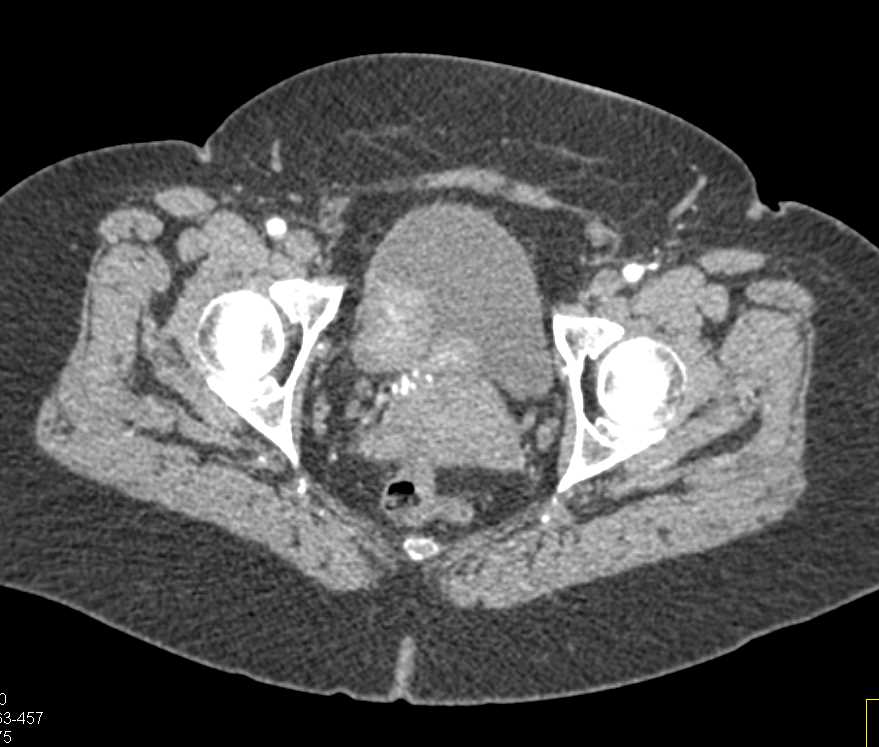 Bladder Cancer Right Wall of the Bladder - CTisus CT Scan