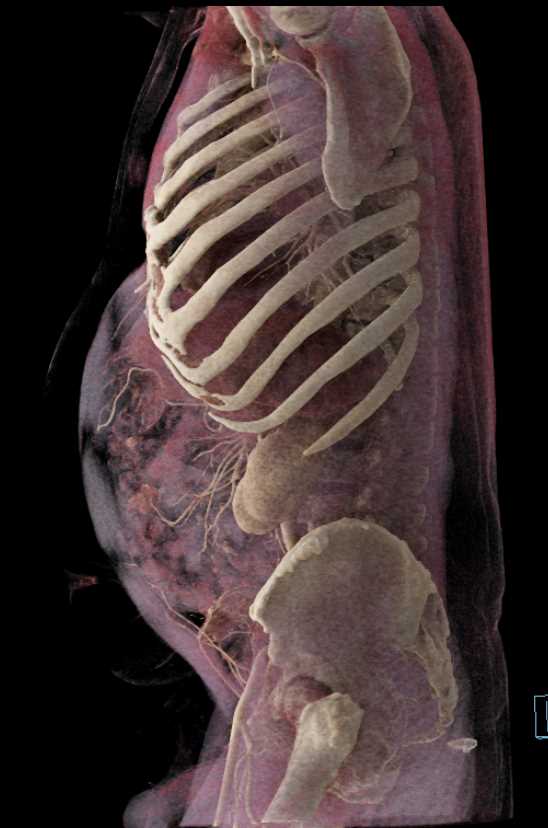 Polypoid Bladder Cancer - CTisus CT Scan