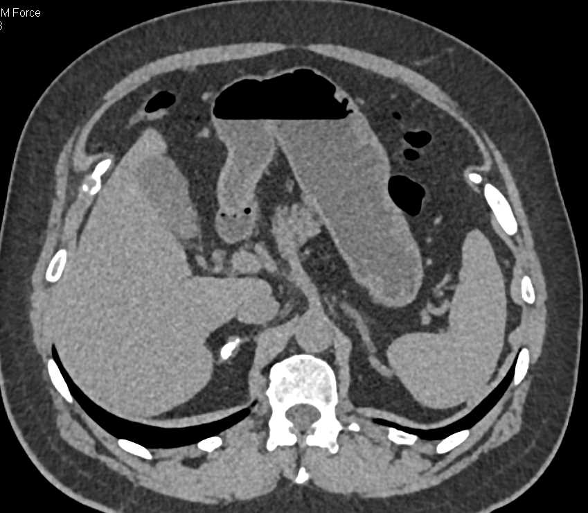 Polypoid Bladder Cancer and Calcified Right Adrenal Gland - CTisus CT Scan