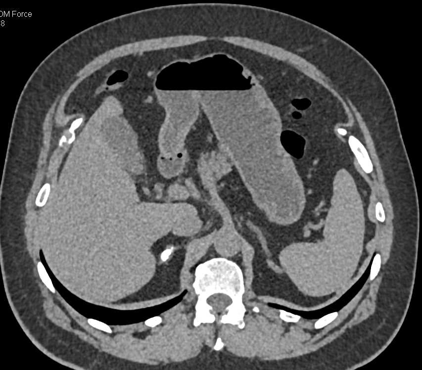 Polypoid Bladder Cancer and Calcified Right Adrenal Gland - CTisus CT Scan