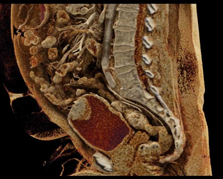 Bladder Cancer - CTisus CT Scan