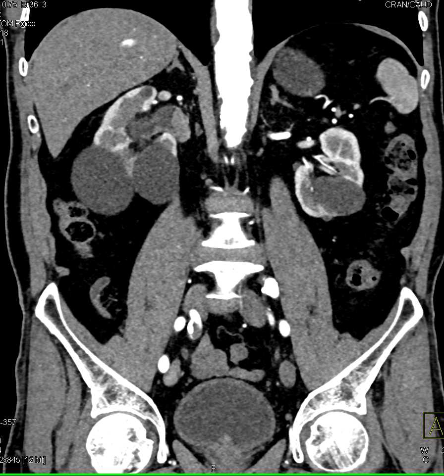 Transitional Cell Carcinoma Right Kidney and Bladder - CTisus CT Scan