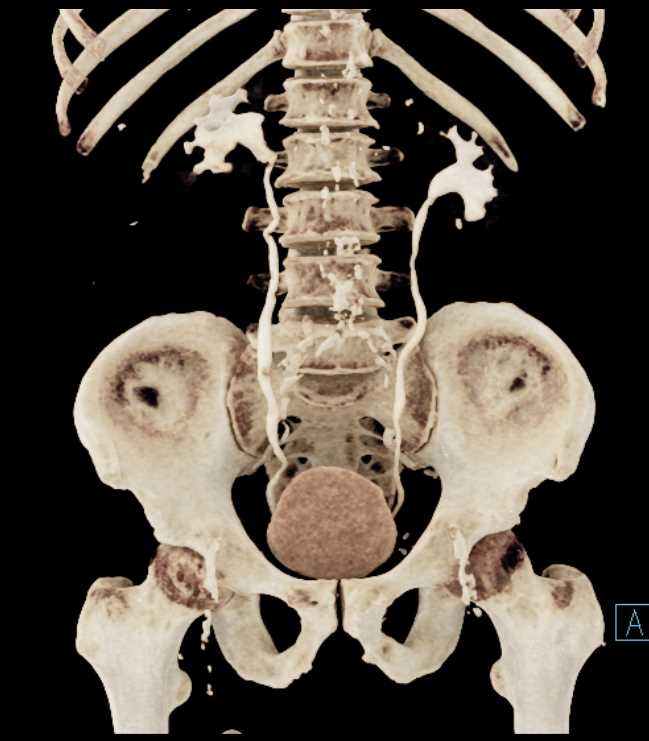 Transitional Cell Carcinoma Right Kidney and Bladder - CTisus CT Scan