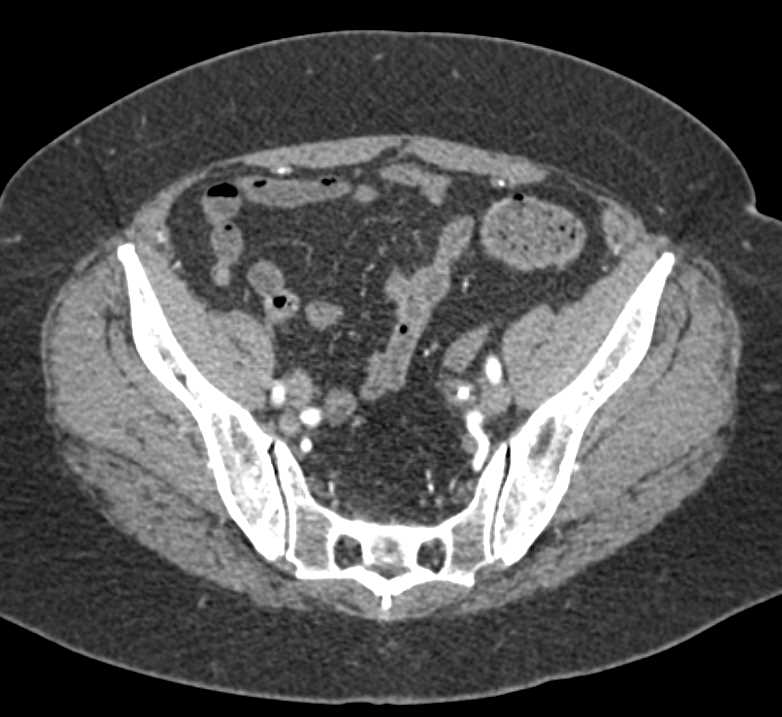Obstructing Stone in the Left Ureter - CTisus CT Scan