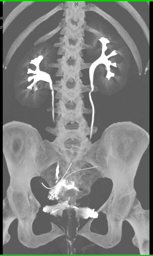Extravasation from the Bladder - CTisus CT Scan