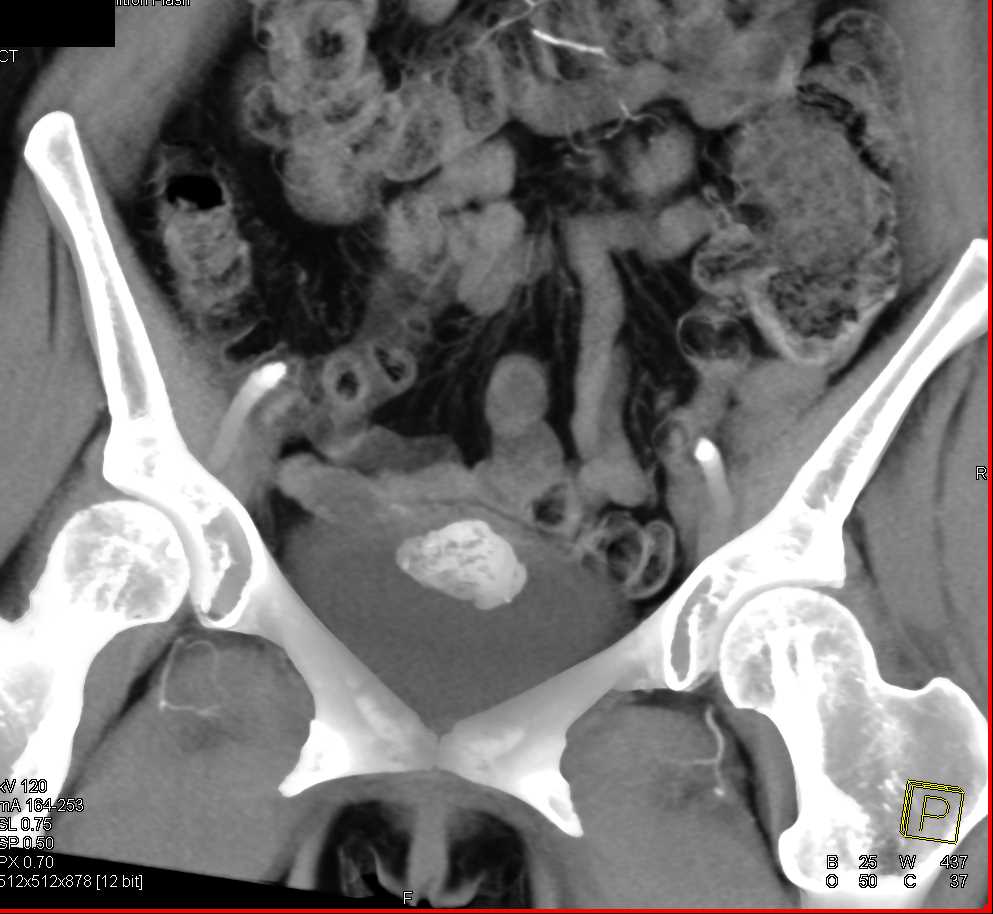 Urachal Carcinoma of the Bladder - CTisus CT Scan