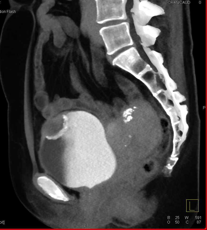 Urachal Carcinoma of the Bladder - CTisus CT Scan