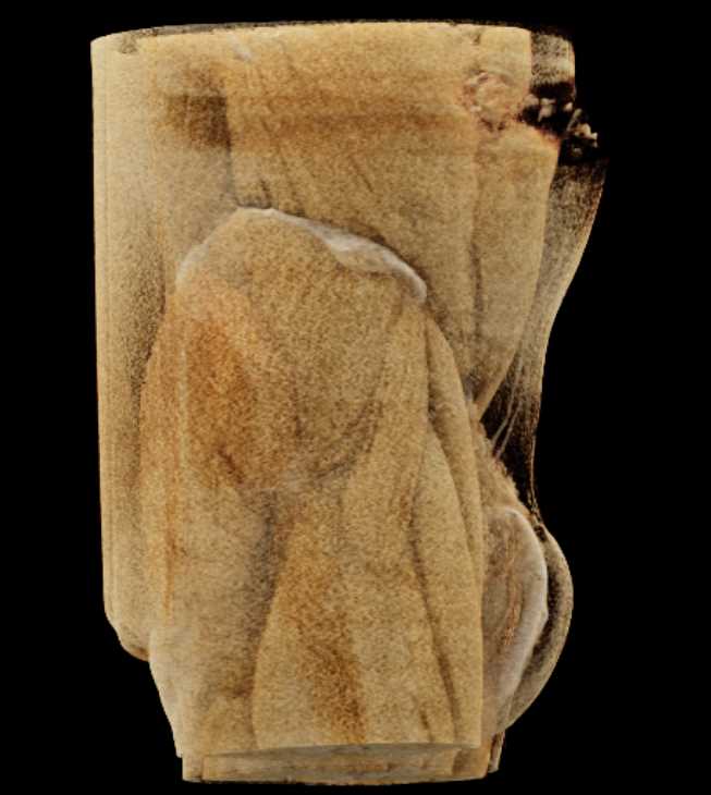 Penile Prosthesis - CTisus CT Scan