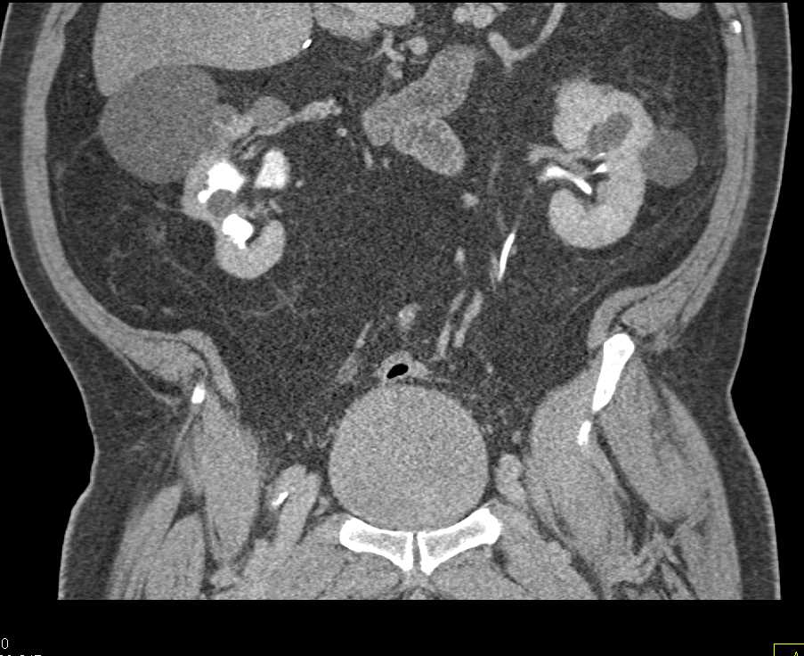 Bladder Diverticulum - CTisus CT Scan