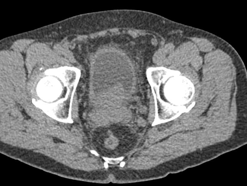 Prostate Cancer - CTisus CT Scan