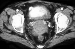 Cystitis - CTisus CT Scan