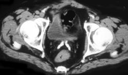 Calcified Seminal Vesicles - CTisus CT Scan