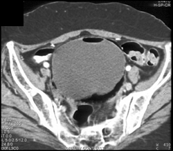 Emphysematous Cystitis - CTisus CT Scan