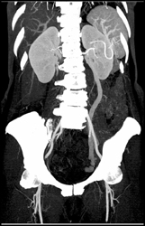 Dilated Left Gonadal Vein - CTisus CT Scan