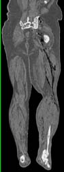 Necrotizing Fasciitis - CTisus CT Scan