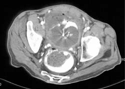 Colovesical Fistulae - CTisus CT Scan