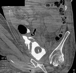 Leak From Bladder on CT Cystogram - CTisus CT Scan