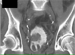 Neobladder - CTisus CT Scan