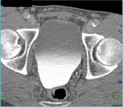 Dilated Left Ureter - CTisus CT Scan