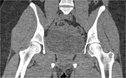 Plaque in LAD - CTisus CT Scan