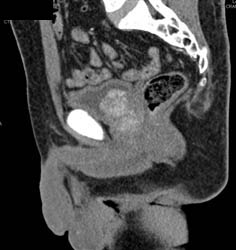 Blood Clot in Bladder - CTisus CT Scan