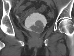 Bulky Bladder Cancer - CTisus CT Scan