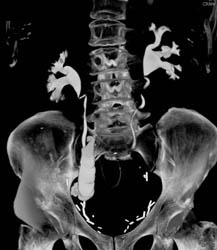 Ct Urogram With Neobladder - CTisus CT Scan