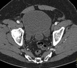 Bladder Diverticulum - CTisus CT Scan