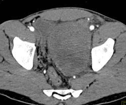 Prostate Sarcoma - CTisus CT Scan