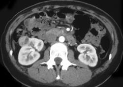 2cm Renal Cell Carcinoma - CTisus CT Scan