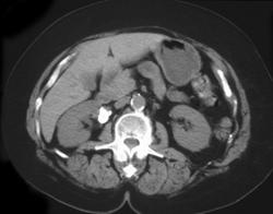 Renal Artery Aneurysm - CTisus CT Scan