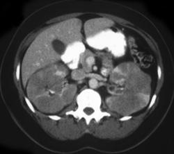 Renal Lymphoma - CTisus CT Scan